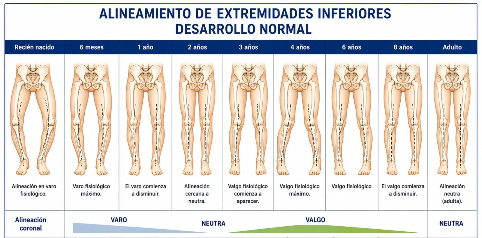 Infografía del desarrollo normal del alineamiento coronal de las piernas, del recién nacido a la adultez: varo fisiológico, alineación neutra y valgo fisiológico