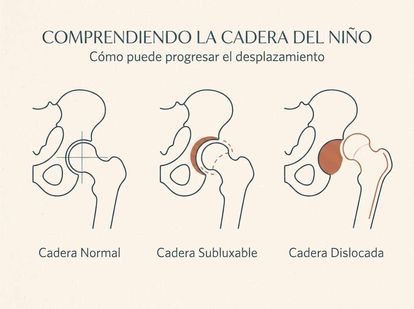 Espectro de severidad de la displasia de cadera: cadera normal, subluxable y dislocada