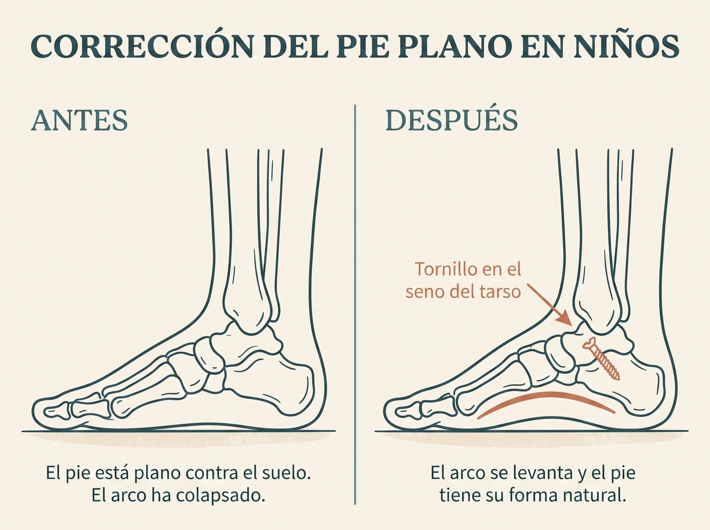 Antes y después de la corrección del pie plano con la técnica Calcáneo Stop