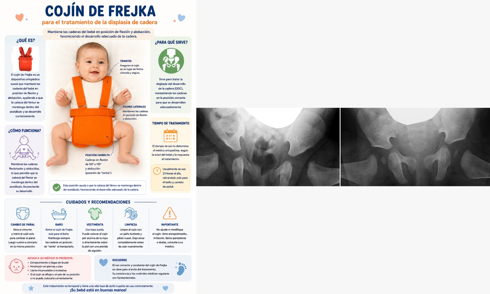 Cojín de Frejka — tratamiento displasia de cadera
