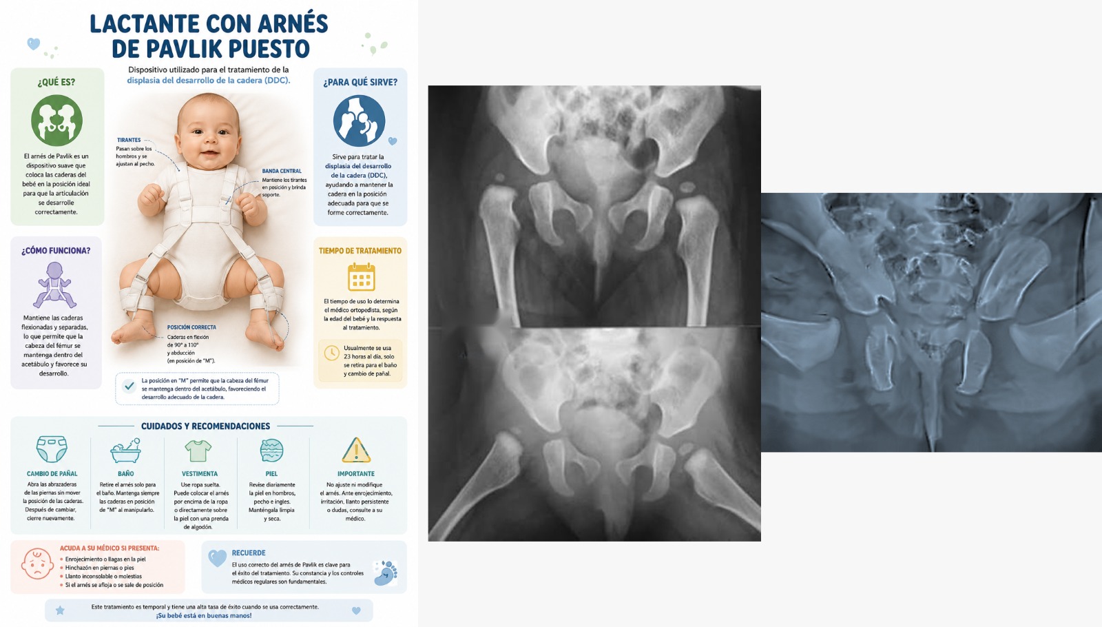 Arnés de Pavlik — tratamiento displasia de cadera