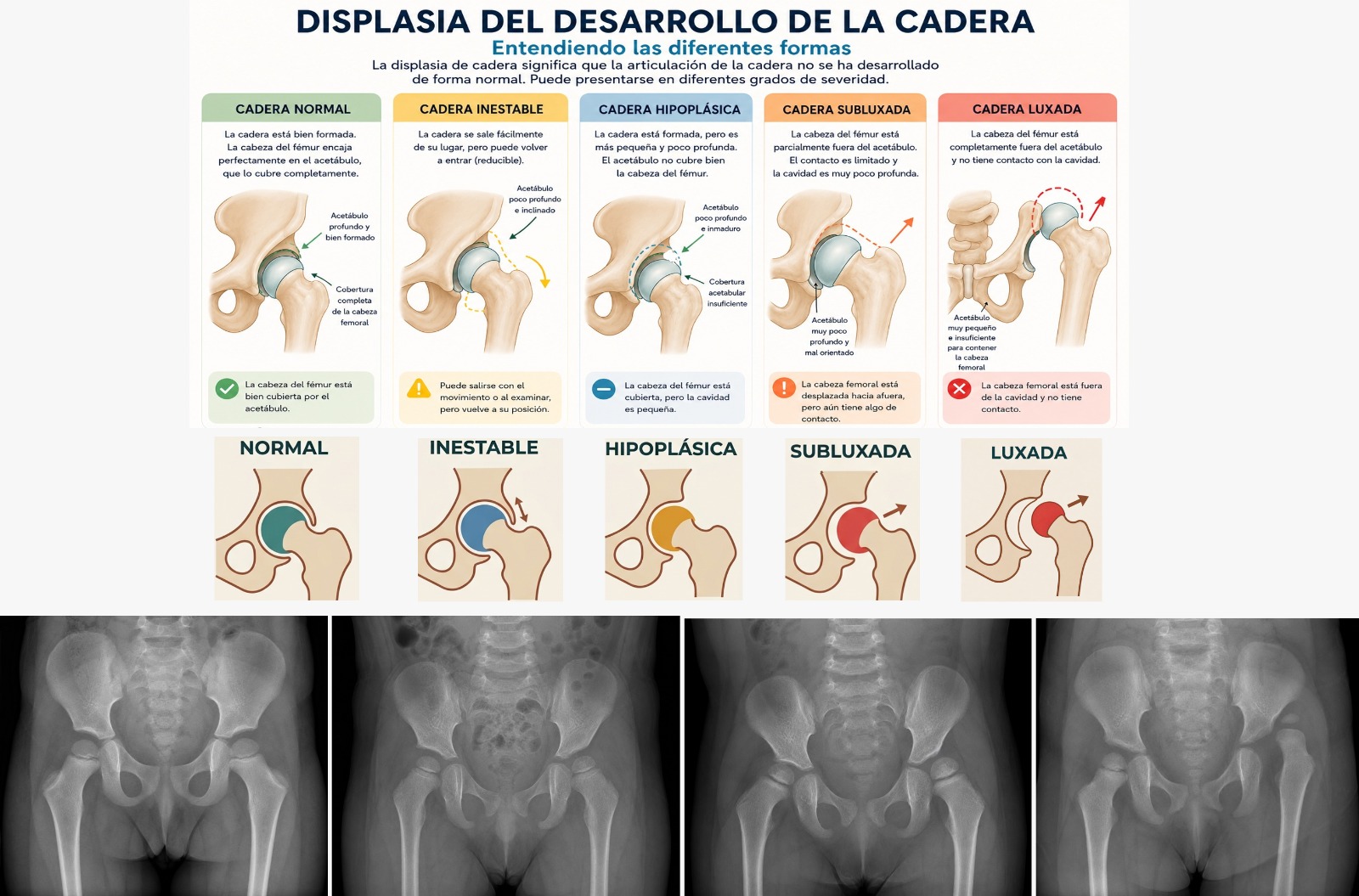 Displasia del Desarrollo de la Cadera — tipos